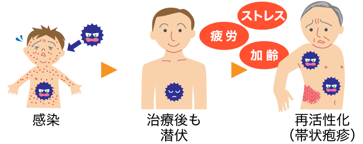 帯状疱疹に感染したら